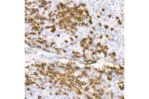 Immunohistochemistry of paraffin-embedded Human Hodgkin lymphoma using CD20 antibody (ABIN7268472) at dilution of 1:100 (40x lens).