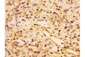 Immunohistochemistry of paraffin-embedded human glioma using ABIN7145966 at dilution of 1:100 (CCL17 抗体  (AA 24-94))