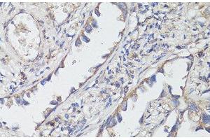 Immunohistochemistry of paraffin-embedded Human lung cancer using TrkB Polyclonal Antibody at dilution of 1:200 (40x lens). (TRKB 抗体)