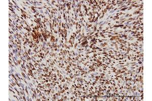 Immunoperoxidase of monoclonal antibody to TARDBP on formalin-fixed paraffin-embedded human leiomyosarcoma tissue [antibody concentration 3 ug/ml] (TARDBP 抗体  (AA 1-260))