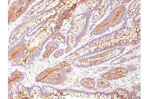Formalin-fixed, paraffin-embedded human Colon Carcinoma stained with CEA Mouse Monoclonal Antibody (COL-1). (CEACAM5 抗体)