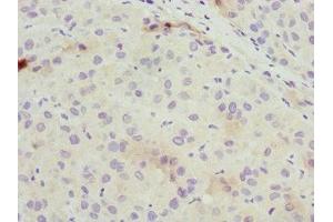 Immunohistochemistry of paraffin-embedded human liver cancer using ABIN7162309 at dilution of 1:100 (Osteocalcin 抗体  (AA 52-100))