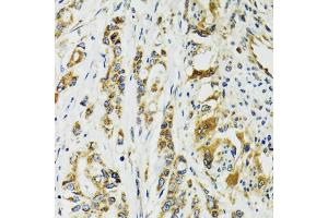 Immunohistochemistry of paraffin-embedded human colon carcinoma using TNNC1 antibody. (TNNC1 抗体)