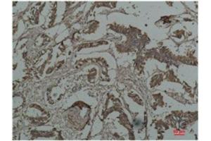 Immunohistochemistry (IHC) analysis of paraffin-embedded Human Breast Carcicnoma using HSP27 Mouse Monoclonal Antibody diluted at 1:200.