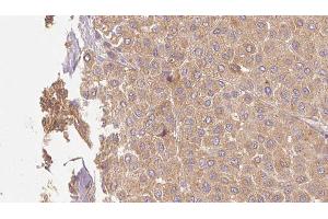 ABIN6273509 at 1/100 staining Human Melanoma tissue by IHC-P. (GZMM 抗体  (Internal Region))