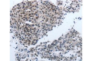 Immunohistochemistry of Human liver cancer using NPR1 Polyclonal Antibody at dilution of 1:40 (NPR1 抗体)