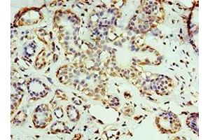 Immunohistochemistry of paraffin-embedded human breast cancer using ABIN7167670 at dilution of 1:100 (RNLS 抗体  (AA 18-342))