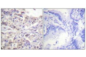 Immunohistochemical analysis of paraffin-embedded human lung carcinoma tissue using hnRPD (Phospho-Ser83) antibody (left)or the same antibody preincubated with blocking peptide (right). (HNRNPD/AUF1 抗体  (pSer83))