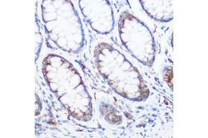Immunohistochemistry of paraffin-embedded human colon carcinoma using NOMO1 Rabbit pAb (ABIN6128346, ABIN6144710, ABIN6144711 and ABIN6214793) at dilution of 1:350 (40x lens). (NOMO1 抗体  (AA 700-1000))