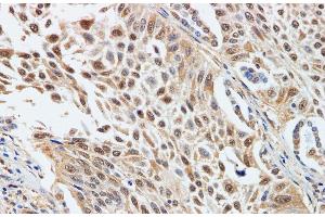 Immunohistochemistry of paraffin-embedded Human lung cancer using CDK4 Polyclonal Antibody at dilution of 1:200 (CDK4 抗体)