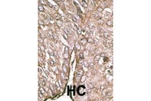 Formalin-fixed and paraffin-embedded human cancer tissue reacted with the primary antibody, which was peroxidase-conjugated to the secondary antibody, followed by DAB staining. (MAP1LC3A 抗体  (AA 23-52))