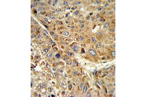 Formalin-fixed and paraffin-embedded human hepatocarcinoma reacted with GPX1 Antibody (C-term), which was peroxidase-conjugated to the secondary antibody, followed by DAB staining. (Glutathione Peroxidase 1 抗体  (C-Term))