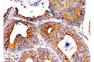Anti-Integrin alpha 1 antibody,  IHC(P) IHC(P): Human Intestinal Cancer Tissue (Integrin alpha 1 抗体  (C-Term))