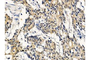 ABIN7094203 and ABIN7098249 at 1/100 staining human colorectal cancer by IHC-P.