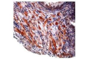 Tgf beta 1 in prostate cancer was detected using TGFB1 antibody at a dilution of 5-10 ug/ml and stained with HRP/AEC red color stain. (TGFB1 抗体  (Middle Region))