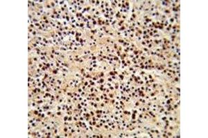 IHC analysis of FFPE human lymphoma stained with LCK antibody (LCK 抗体  (AA 480-509))
