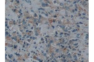 IHC-P analysis of Human Prostate cancer Tissue, with DAB staining. (ECE1 抗体  (AA 469-721))