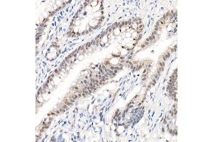 Immunohistochemistry of paraffin-embedded human colon carcinoma using Phospho--S473 Rabbit pAb (ABIN1513328, ABIN5664973, ABIN5664975 and ABIN6225474) at dilution of 1:50 (40x lens). (AKT1 抗体  (pSer473))