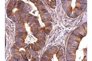 IHC-P Image Survivin antibody detects Survivin protein at cytosol on human colon carcinoma by immunohistochemical analysis. (Survivin 抗体)