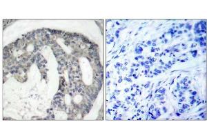 Immunohistochemical analysis of paraffin-embedded human breast carcinoma tissue using eNOS (phospho-Ser1176) antibody (E011156). (ENOS 抗体  (pSer1176))
