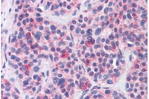 Anti-MBOAT4 antibody  ABIN1102980 IHC staining of human thyroid, medullary carcinoma. (MBOAT4 抗体  (Internal Region))