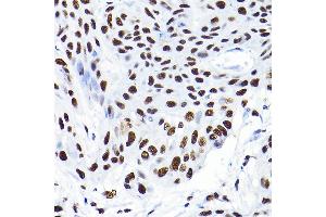 Immunohistochemistry of paraffin-embedded human esophageal cancer using K/K/TRIM28 Rabbit pAb  at dilution of 1:200 (40x lens). (KAP1 抗体  (AA 576-835))
