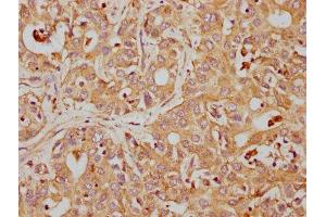 IHC image of ABIN7127407 diluted at 1:155 and staining in paraffin-embedded human liver cancer performed on a Leica BondTM system. (Recombinant CD63 抗体)