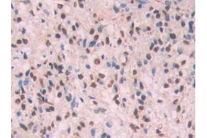 Detection of Ab1-42 in Human Glioma Tissue using Monoclonal Antibody to Amyloid Beta Peptide 1-42 (Ab1-42) (Abeta 1-42 抗体)