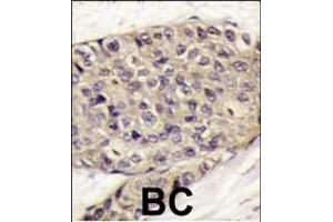 Formalin-fixed and paraffin-embedded human breast carcinoma tissue reacted with VEGF Antibody (C-term) (ABIN6242881 and ABIN6578974) , which was peroxidase-conjugated to the secondary antibody, followed by DAB staining. (VEGF 抗体  (C-Term))