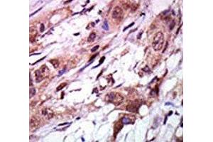 IHC analysis of FFPE human breast carcinoma tissue stained with the AURKC antibody (Aurora Kinase C 抗体  (C-Term))