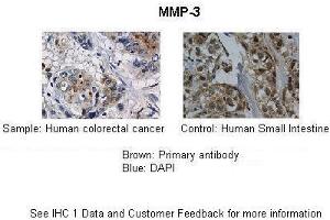 Application: IHC Species+tissue/cell type: Control-Human small intestine, Sample-human colorectal cancer Primary antibody dilution: 1:100 Secondary antibody: Biotinylated pig anti-rabbit+streptavidin-HRP (MMP3 抗体  (Middle Region))