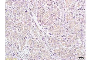Formalin-fixed and paraffin embedded human endometrial carcinoma labeled with Anti-STIM1 Polyclonal Antibody, Unconjugated (ABIN1387605) at 1:200 followed by conjugation to the secondary antibody and DAB staining (STIM1 抗体  (AA 85-180))