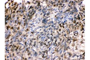 Anti- HSPA2 Picoband antibody,IHC(P) IHC(P): Human Lung Cancer Tissue (HSPA2 抗体  (C-Term))