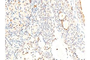 Immunohistochemistry (IHC) image for anti-Receptor tyrosine-protein kinase erbB-2 (ErbB2/Her2) (pTyr1248) antibody (ABIN6256630)