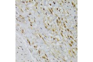Immunohistochemistry of paraffin-embedded human adenomyosis using HNRNPA1 Antibody (ABIN5975570) at dilution of 1/100 (40x lens). (HNRNPA1 抗体)