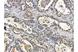 ABIN6258547 and ABIN6275031 at 1/100 staining human ovarian cancer by IHC-P. (C1QL2 抗体  (C-Term))