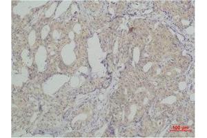 Immunohistochemistry (IHC) analysis of paraffin-embedded Human Breast Carcicnoma using SLUG Polyclonal Antibody. (SLUG 抗体)