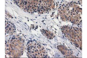 Immunohistochemical staining of paraffin-embedded Adenocarcinoma of Human breast tissue using anti-GBA3 mouse monoclonal antibody. (GBA3 抗体  (AA 1-150, AA 370-469))