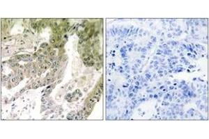 Immunohistochemistry analysis of paraffin-embedded human lung carcinoma tissue, using LAMA5 Antibody. (Laminin alpha 5 抗体  (AA 2381-2430))