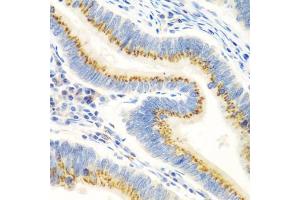 Immunohistochemistry of paraffin-embedded human colon carcinoma using UBI antibody (ABIN6134946, ABIN6149845, ABIN6149848 and ABIN6223555) at dilution of 1:100 (40x lens). (UBIAD1 抗体  (AA 1-100))