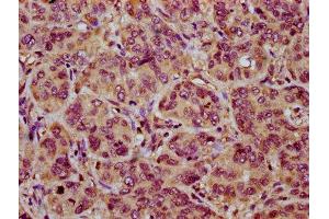 IHC image of ABIN7161019 diluted at 1:200 and staining in paraffin-embedded human liver cancer performed on a Leica BondTM system. (NOXO1 抗体  (AA 304-376))