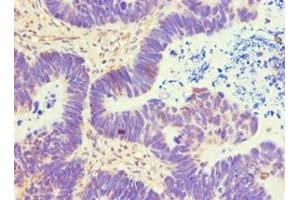 Immunohistochemistry of paraffin-embedded human ovarian cancer using ABIN7144840 at dilution of 1:100 (ATP5B 抗体  (AA 230-529))