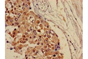 Immunohistochemistry of paraffin-embedded human breast cancer using ABIN7146825 at dilution of 1:100 (CRAT 抗体  (AA 181-346))
