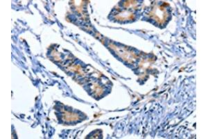 The image on the left is immunohistochemistry of paraffin-embedded Human colon cancer tissue using ABIN7191031(IBSP Antibody) at dilution 1/50, on the right is treated with synthetic peptide. (IBSP 抗体)