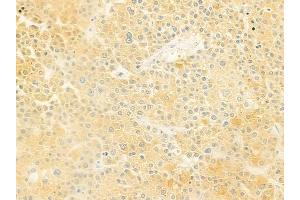 ABIN6261135 and ABIN6278939 at 1/100 staining human hepatocellular carcinoma by IHC-P.