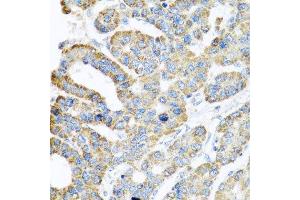 Immunohistochemistry of paraffin-embedded human liver cancer using ATPIF1 antibody at dilution of 1:100 (x40 lens). (ATPase Inhibitory Factor 1 抗体)
