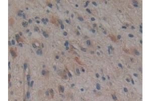 Detection of TTK in Human Glioma Tissue using Polyclonal Antibody to TTK Protein Kinase (TTK)
