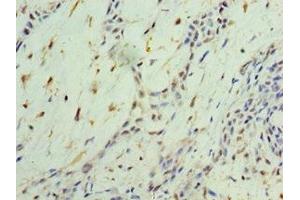 Immunohistochemistry of paraffin-embedded human breast cancer using ABIN7161910 at dilution of 1:100