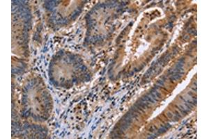 The image on the left is immunohistochemistry of paraffin-embedded Human colon cancer tissue using ABIN7129424(FAAH2 Antibody) at dilution 1/30, on the right is treated with fusion protein. (FAAH2 抗体)