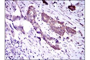 Immunohistochemical analysis of paraffin-embedded esophageal cancer tissues using DNAL4 mouse mAb with DAB staining. (DNAL4 抗体  (AA 1-105))